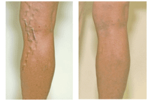 Dialysis Access Surgery Before & after image of patient leg