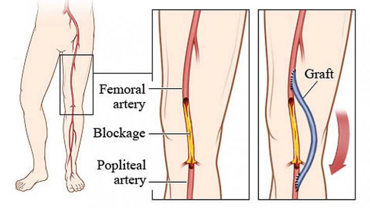 Lower Limb Bypass Surgery